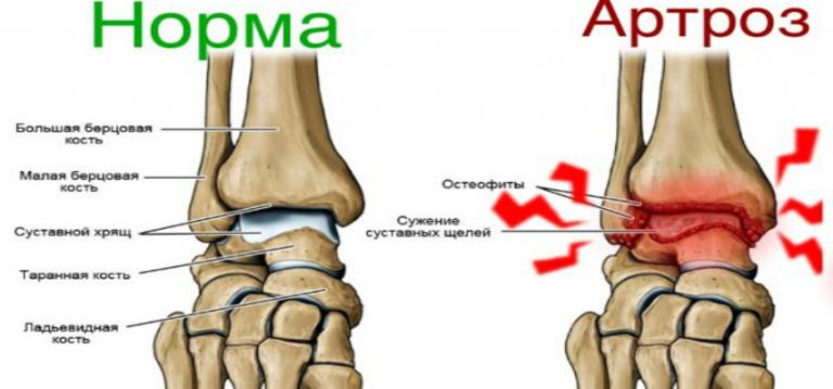 Тейпирование коленного сустава при артрозе схема фото