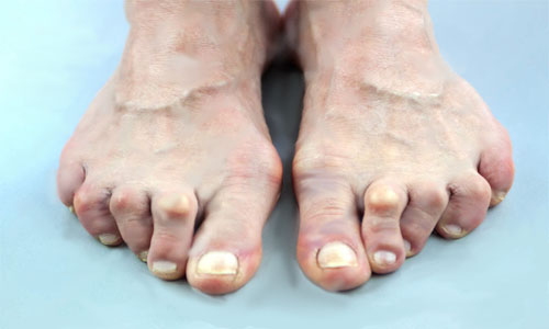 Артрит суставов пальцев ног симптомы и лечение 198