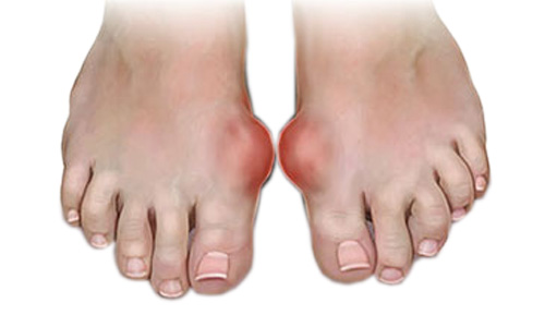 Артрит суставов пальцев ног симптомы и лечение 98