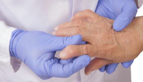 Артрит суставов рук симптомы лечение 51