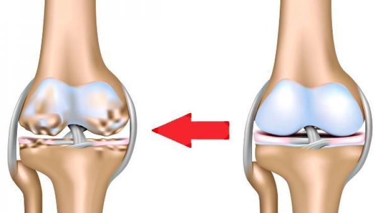Артроз коленного сустава мениск. Остеоартрит коленного сустава. Разрушение хрящевой ткани коленного сустава.