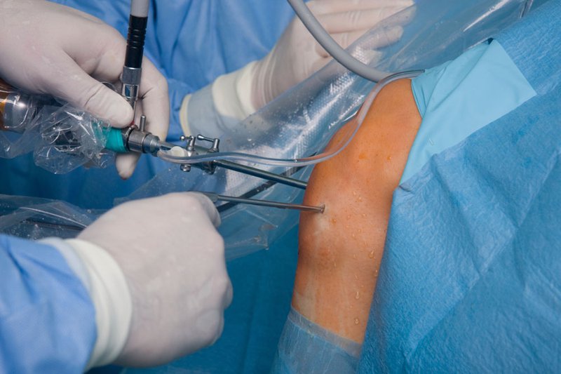 Артроскопия передней крестообразной связки коленного сустава восстановление 73