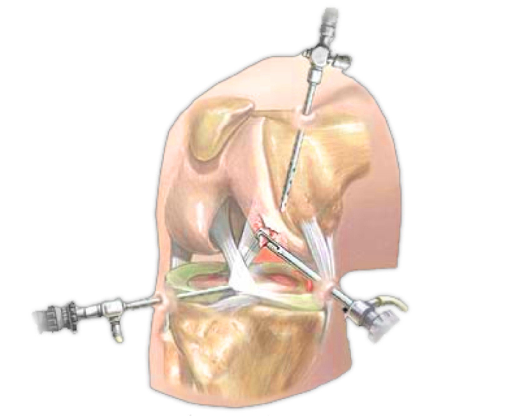 Артроскопия передней крестообразной связки коленного сустава восстановление 149