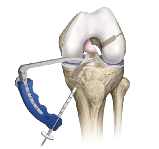 Артроскопия пкс коленного сустава 99