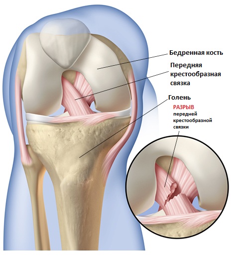Артроскопия пкс коленного сустава 8