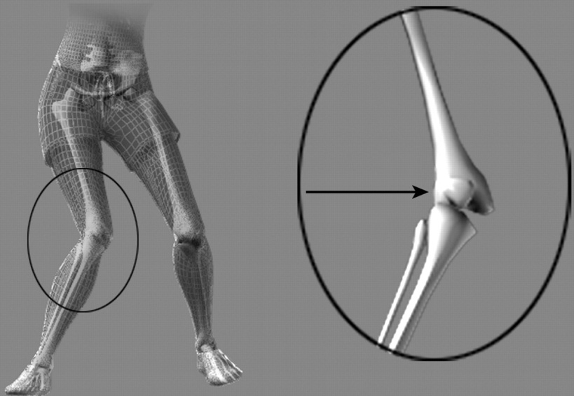 Артроскопия пкс коленного сустава 139