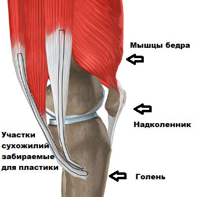 Артроскопия пкс коленного сустава 60