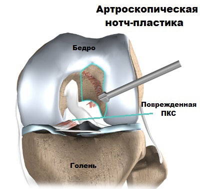 Артроскопия пкс коленного сустава 143