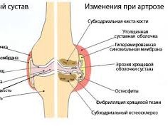 Артроз коленного сустава лечение в домашних условиях 6