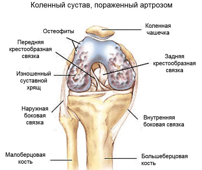 Артроз коленного сустава симптомы народные средства 72