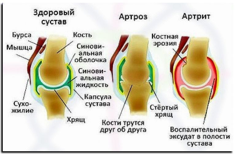 Артрозный артрит коленного сустава 21
