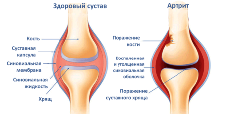 Артрозный артрит коленного сустава 101