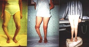 Артрозный артрит коленного сустава 52