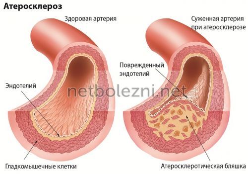 Атеросклероз суставов нижних конечностей 4
