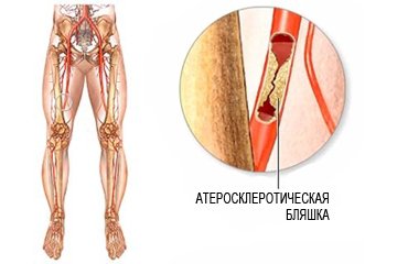 Атеросклероз суставов нижних конечностей 112