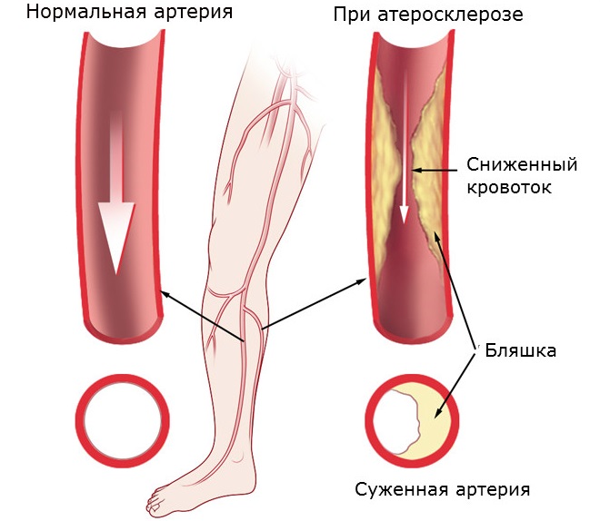 Атеросклероз суставов нижних конечностей 168