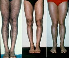 Биомеханика коленного сустава человека 101