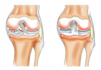 Блокада коленного сустава при разрыве мениска 54
