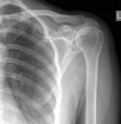 Боль плечевого сустава какой врач лечит 165