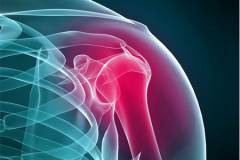Боль плечевого сустава какой врач лечит 125
