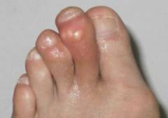 Боль в суставах больших пальцев ног лечение 56