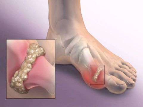 Боль в суставах больших пальцев ног лечение 153