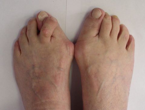 Боль в суставах больших пальцев ног лечение 57