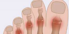 Боль в суставах больших пальцев ног лечение 99