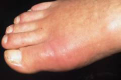 Боль в суставах больших пальцев ног лечение 134