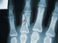 Боль в суставах больших пальцев ног лечение 60