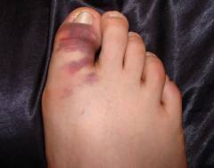 Боль в суставах больших пальцев ног лечение 2