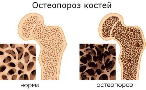 Болезни суставов остеопороз 146
