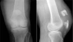 Боли в коленном суставе сзади лечение 56