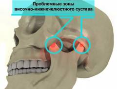 Болит сустав челюсти при открывании рта 113