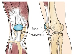 Бурсит коленного сустава симптомы и лечение 68