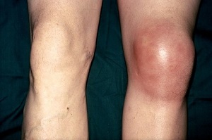 Бурсит коленного сустава симптомы и лечение 135