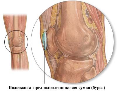 Бурсит коленного сустава симптомы и лечение 141