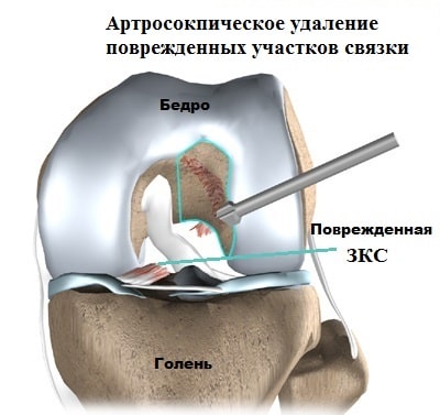 Частичный разрыв задней крестообразной связки коленного сустава 98