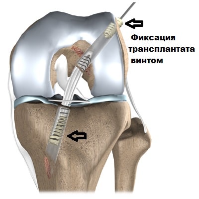 Частичный разрыв задней крестообразной связки коленного сустава 111