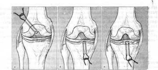 Частичный разрыв задней крестообразной связки коленного сустава 15