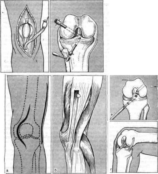 Частичный разрыв задней крестообразной связки коленного сустава 69