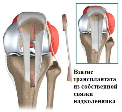 Частичный разрыв задней крестообразной связки коленного сустава 84