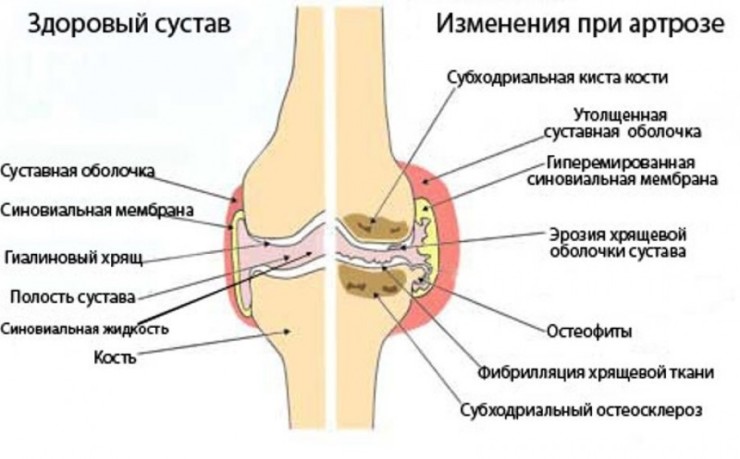 Чем лечить деформирующий остеоартроз коленного сустава 49