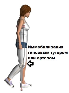 Дисторсия левого коленного сустава 81