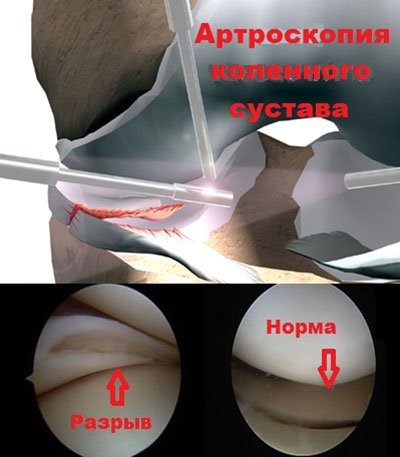 Эндоскопия мениска коленного сустава 113