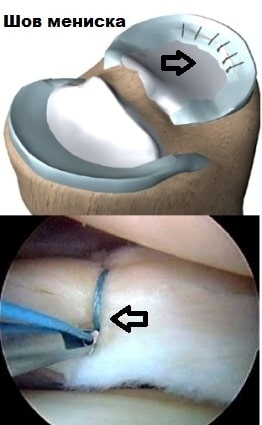 Эндоскопия мениска коленного сустава 119