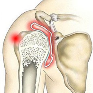 Физиотерапия при артрите плечевого сустава 134