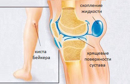 Физиотерапия при кисте бейкера коленного сустава 189