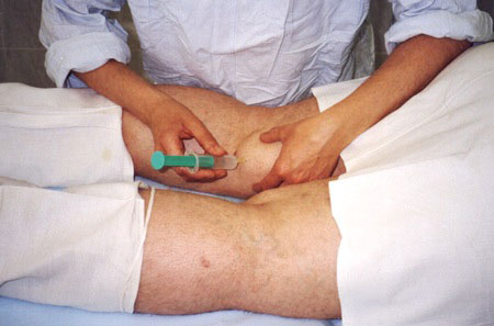 Физиотерапия при кисте бейкера коленного сустава 185