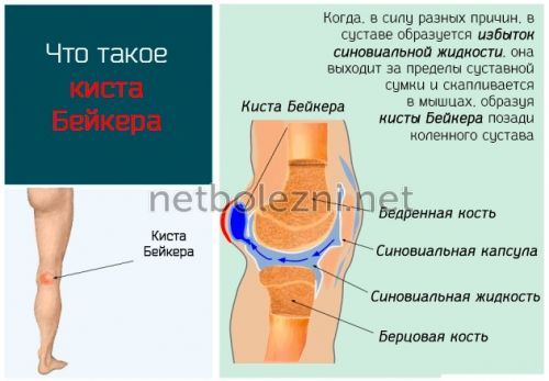 Физиотерапия при кисте бейкера коленного сустава 57
